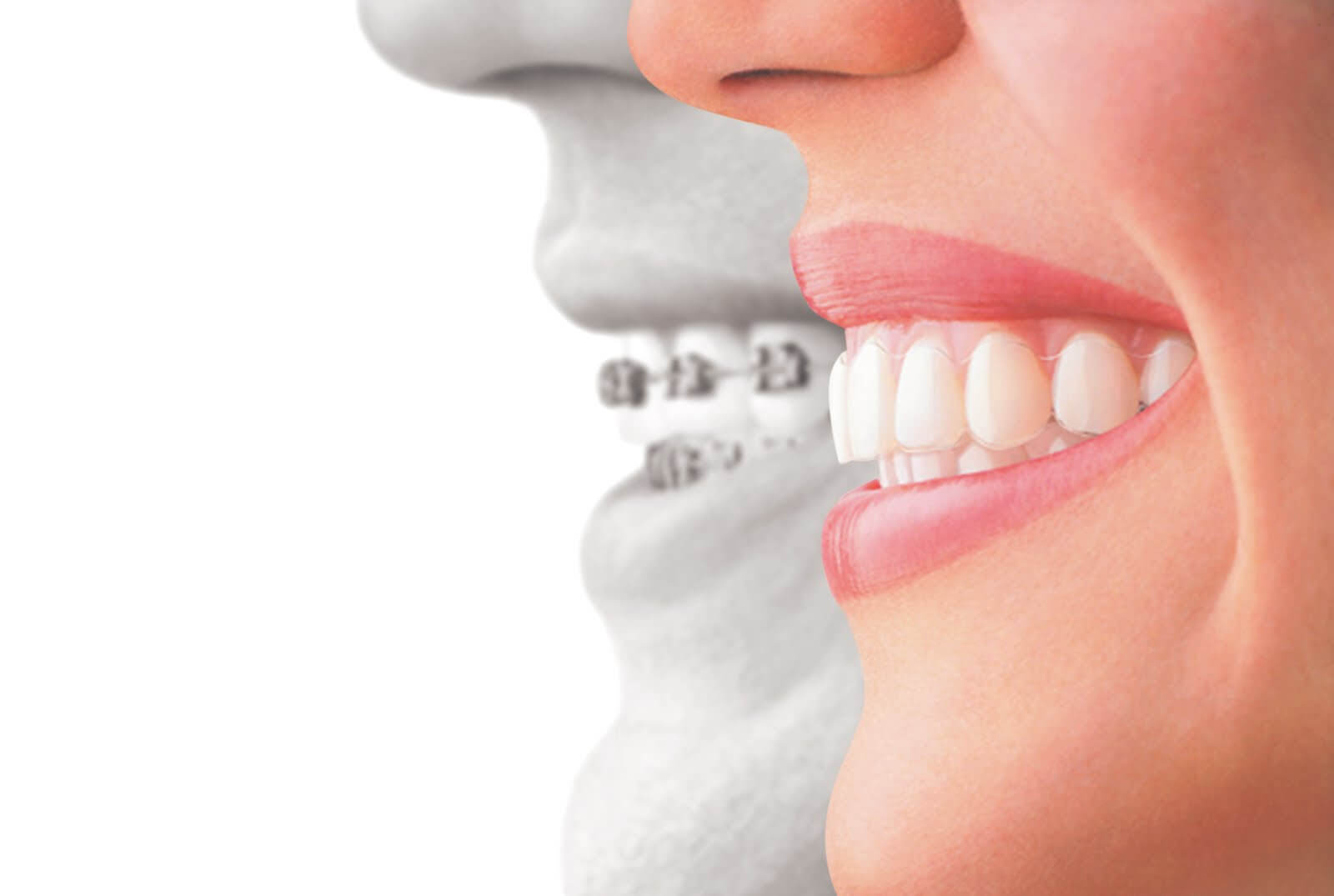 Neden Invisalign’ı Tercih Etmeliyim, Avantajları Nelerdir?