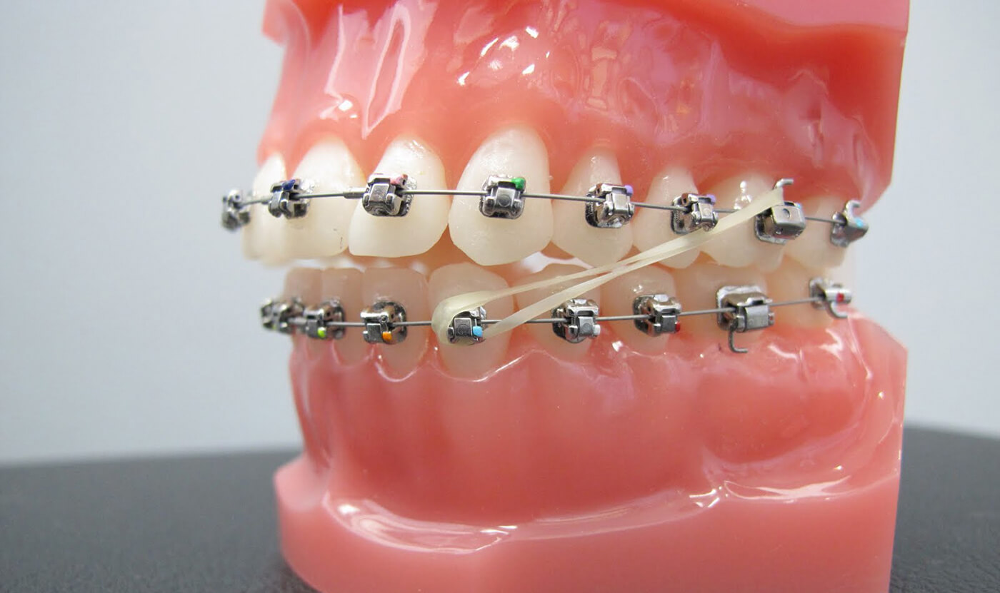 Diş Teli Lastik Takma Nasıl Yapılır?