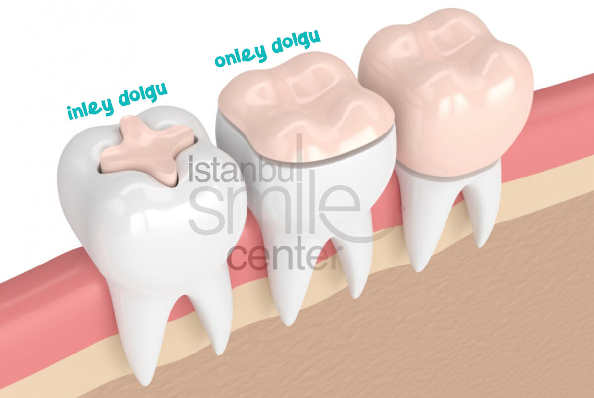 Inley ve Onlay Dolguların Farkı Nedir? Avantajları Nelerdir?
