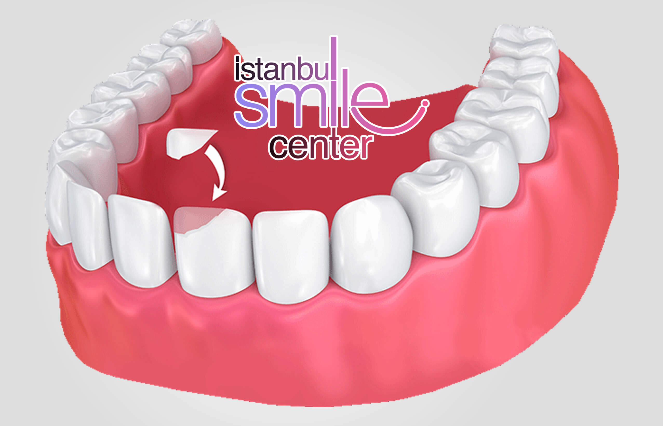 Bonding Nedir? Bonding Tedavisi Fiyatları Ne Kadardır?