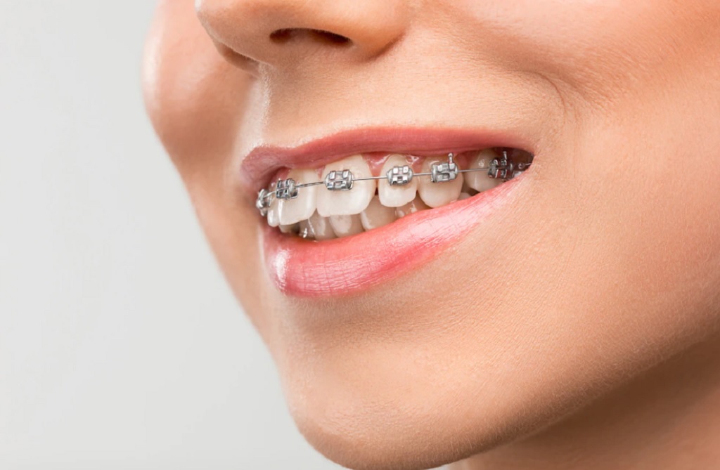 Hızlandırılmış Diş Teli Uygulamasının Avantajları Nelerdir?