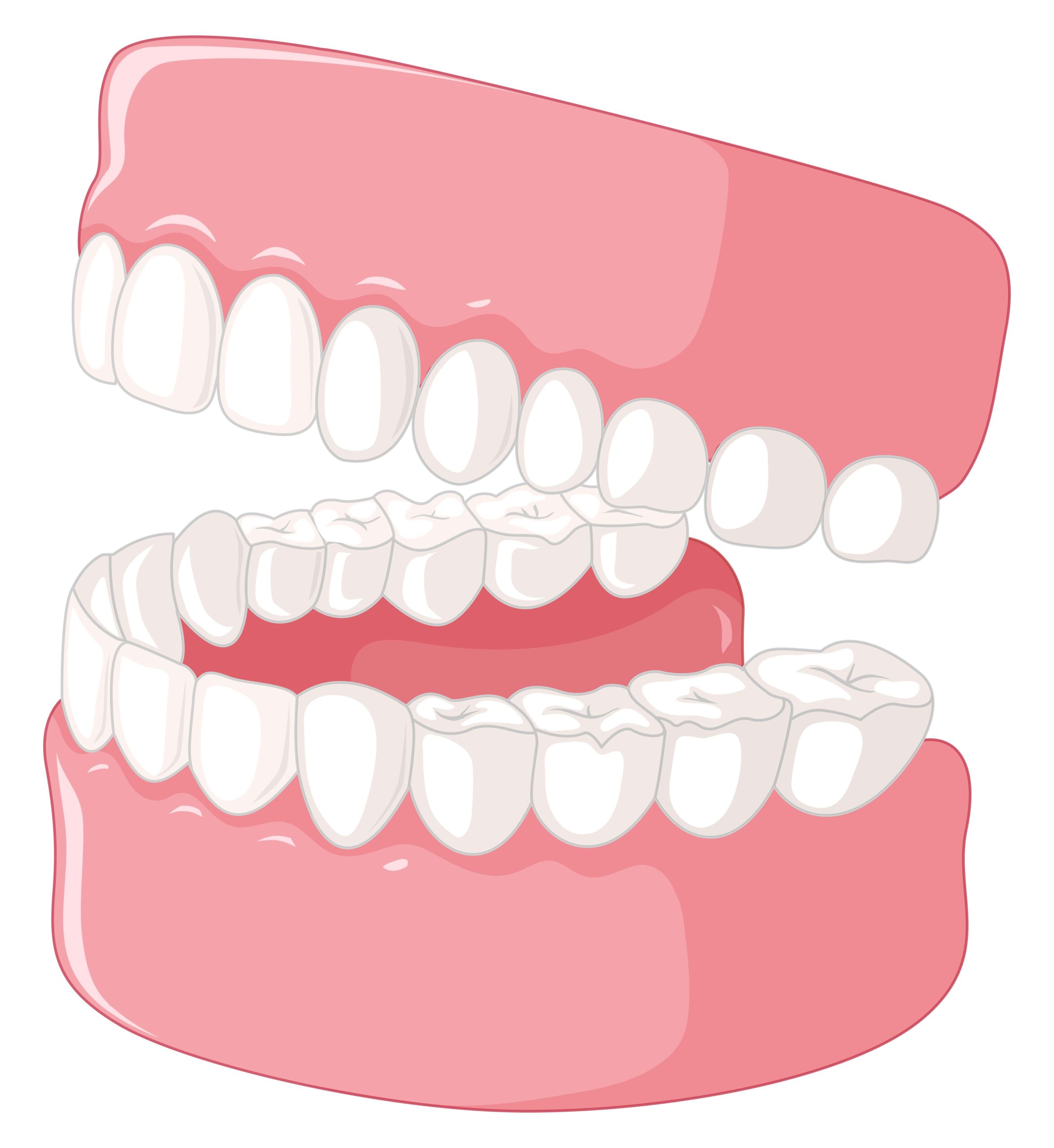 Çarpık Diş Tedavisi