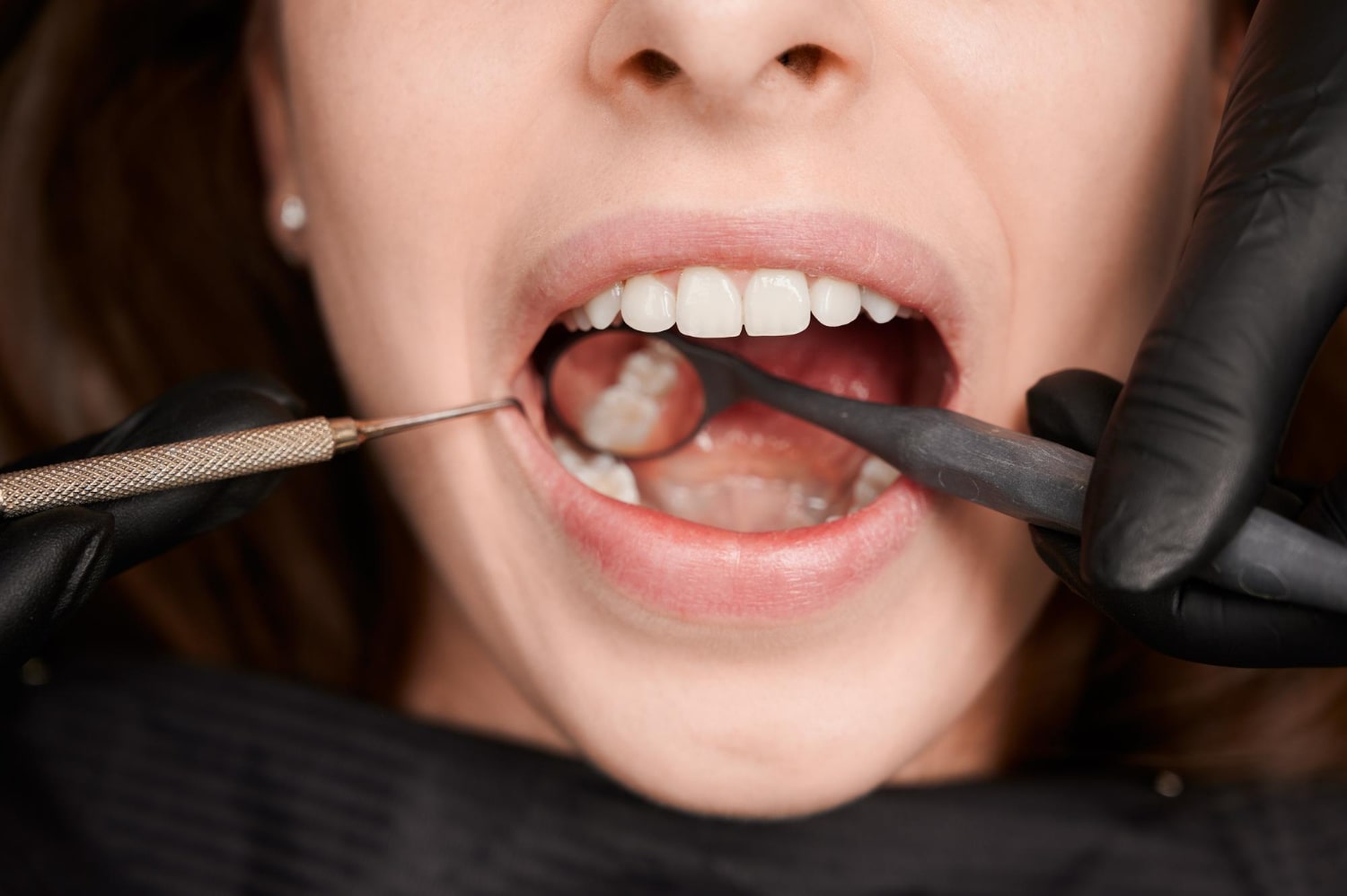 Çarpık Diş Tedavisi