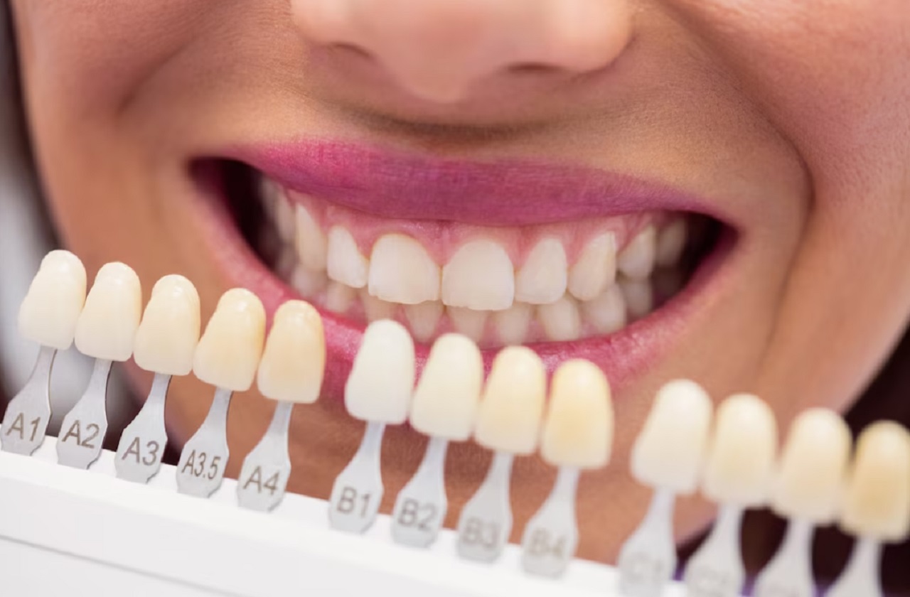 Porselen Diş Kaplama Sonrası Dikkat Etmeniz Gerekenler