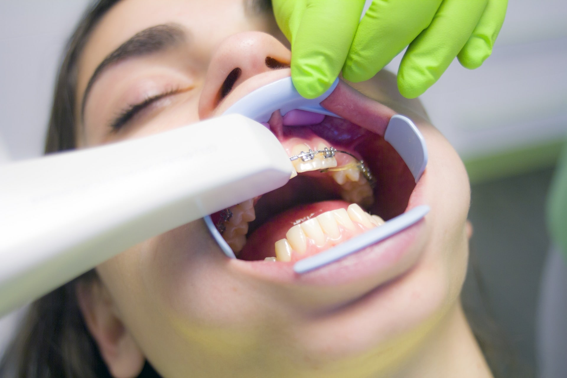 Ortodonti Nedir? Gülüş Tasarımında Kullanılan Yeni Nesil Ortodonti Yöntemleri