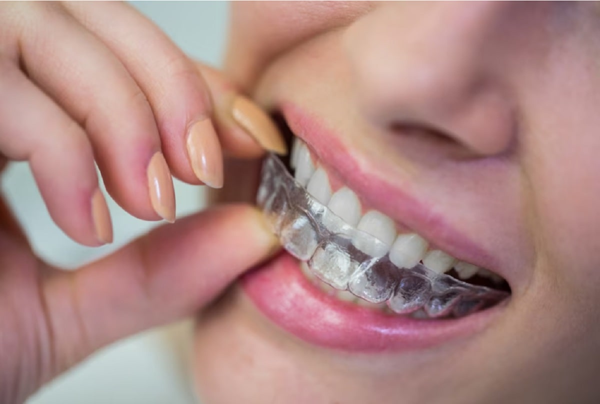 Hızlandırılmış Ortodonti Tedavisi Nasıl Yapılır?
