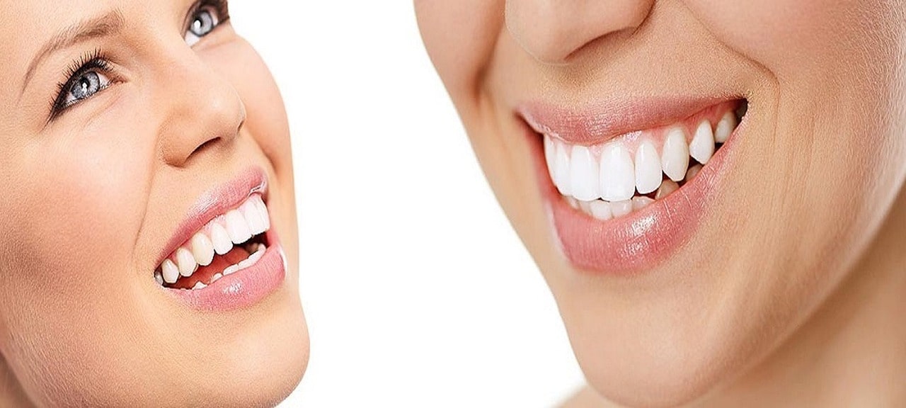 Prepless Veneer Nedir? Prepless Veneer Nasıl Yapılır?