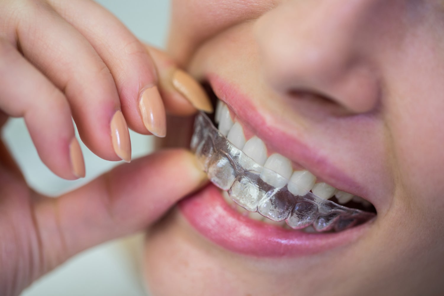 Şeffaf Diş Plağı Tedavisi Nasıl Uygulanır?
