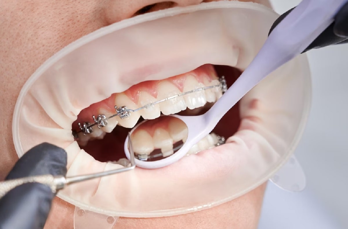 lingual-ortodonti