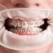 ortodonti-tedavisi