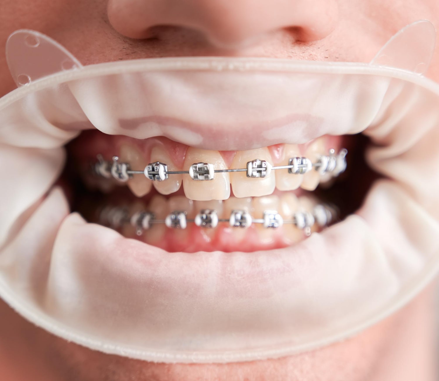 Ortodonti Tedavisi Nedir? Ortodonti Neye Bakar?