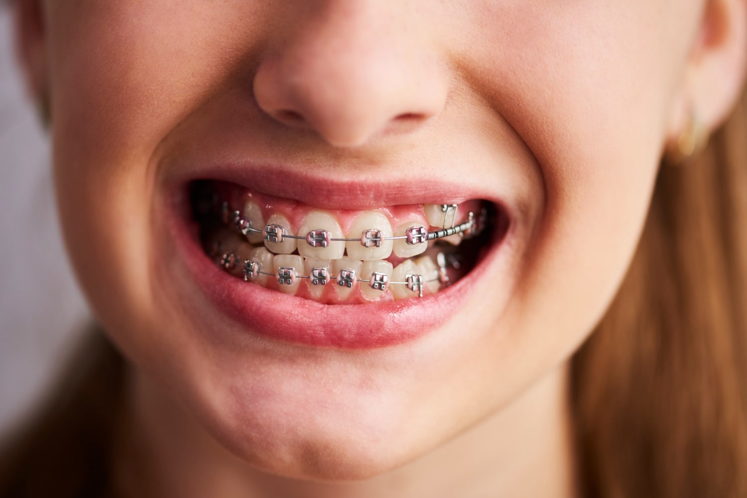 ortodonti-tedavisi